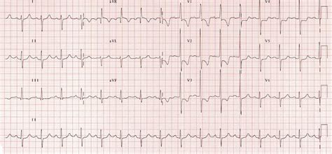 signs of right ventricular strain.